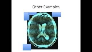 Intraventricular Hemorrhage