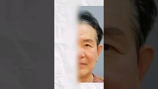 ‍️이마거상 왜 고민하세요..? #강남성형외과 #논현성형외과 #plasticsurgerykorea #이마거상 #lifting #안면거상