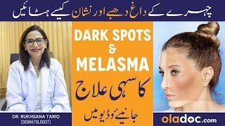 Dark Spots & Pigmentation Treatment - Chehre Ki Daag Dhabe Hatane Ke Liye - What Causes Melasma?