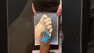 TOE STRAIGHTENING & HAMMERTOE TRANSFORMATION ️#shorts #footsurgery #hammertoes #cornremovalsurgery