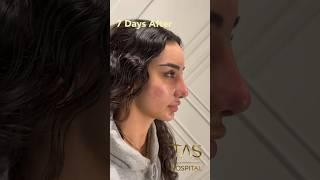 Scarless Facelift and Revision Rhinoplasty by Dr.TAS