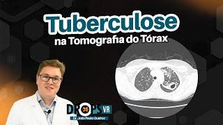 TUBERCULOSE NA TOMOGRAFIA DO TÓRAX I VOCÊ RADIOLOGISTA