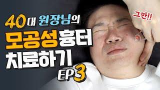 40대 원장님 모공성흉터 치료하기. Ep3.