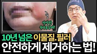 아주 오래된 필러나 이물질이 얼마나 위험한 지 아시나요?#필러부작용#이물질부작용