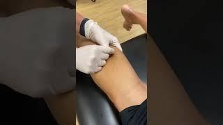 Dry needling for tight calves