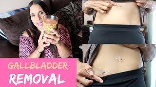 Vlog: What to Expect The 1st Week After Gallbladder Removal Surgery | What I Ate | Scars