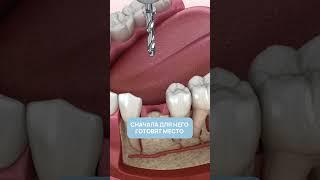 Что такое имплантация Зубов? 