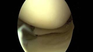 ACL Reconstruction - Dr. Troy Layton - SportsMED Huntsville Alabama