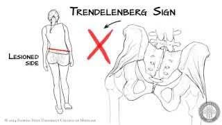 The Trendelenberg Sign [HD]