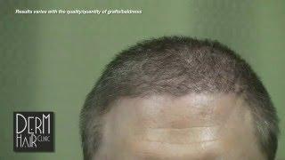 Body hair transplant - My Severe Baldness Cured