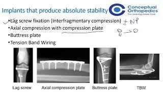 AO Principles of Fracture Management Learn Important Concepts - Conceptual Orthopedics