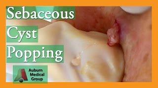 Epidermoid Cyst Popping #popping | Auburn Medical Group