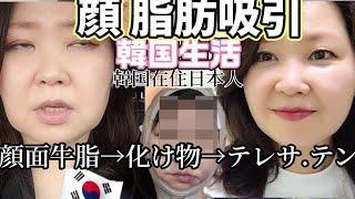 50代 韓国【美容整形】経過公開!!! 脂肪吸引と リフティング!!!!!