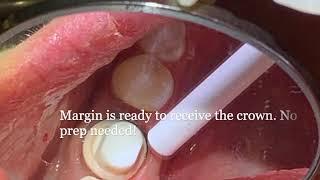 CeraRoot Implant Crown procedure 1 at Family Holistic Dentistry