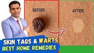 Skin Tags And Warts Will Disappear in 24 Hours - Dr. Vivek Joshi