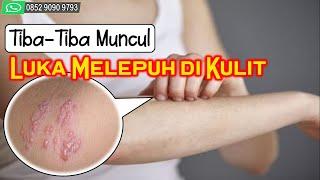 Tiba-Tiba Muncul Luka Melepuh di Kulit