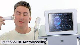 Fractional Radiofrequency Microneedling Skin Tightening | Before & After
