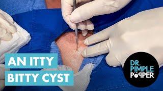 An Itty Bitty Cyst