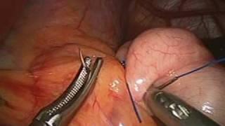 Laparoscopic Gastric banding by Dr Craig Taylor of OClinic Sydney Australia.mpeg