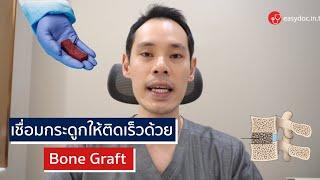 เชื่อมกระดูกให้ติดเร็วด้วย Bone Graft | EasyDoc EP.45