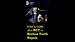 POST & CORE after RCT |Broken Tooth Repair- Dr. Manesh Chandra Sharma| Doctors' Circle #shorts