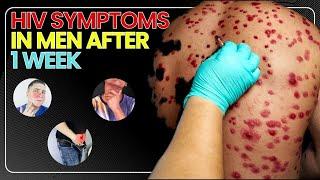 HIV Symptoms in Men After 1 Week
