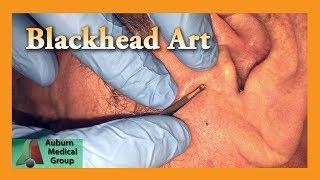 Blackheads Were Requested | Auburn Medical Group