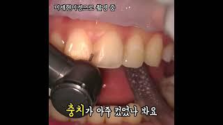 앞니 사이 충치 치료 실제모습 (feat.치과 레진 치료)