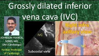 Grossly dilated inferior vena cava and right infra axillary view for IVC