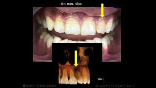 Extraction | Root Canal Treatment | Dental Bridge  | History Of Trauma | Smile galleria | Anand