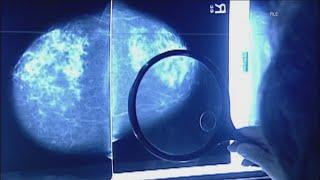 Doctors see growth in young women's breast cancer diagnoses