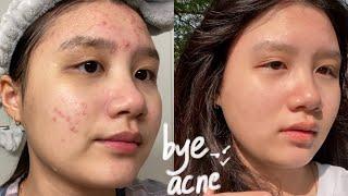 GET RID OF ACNE IN 3 WEEKS | FINALLY, SUCCESS!