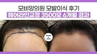   대구헤어라인교정 #여성헤어라인 비절개 3500모 6개월경과 l #경북여성모발이식 #여성탈모치료
