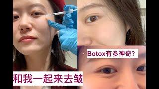 【Botox before after】和我一起来瘦脸抗皱！一周去皱效果大对比