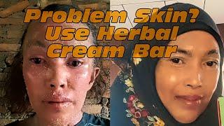 Have Problem Skin? Try Andrographis Paniculata Herbal Cream Bar