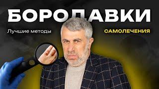 Бородавки: правила профилактики, лечение, самолечение.