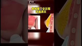 假体隆胸，3D动画演示，让您更了解过程