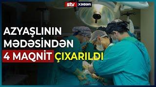 AZYAŞLININ MƏDƏSİNDƏN 4 MAQNİT ÇIXARILDI