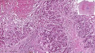 Hepatocellular Carcinoma - Histopathology