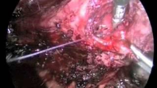 The importance of laparoscopic suturing in dealing with laparoscopic complications