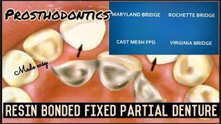 RESIN BONDED FIXED PARTIAL DENTURE II ROCHETTE, MARYLAND, CAST MESH, VIRGINIA BRIDGES II FPD II easy