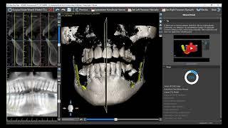 Making Your First Surgical Guide From A to Z