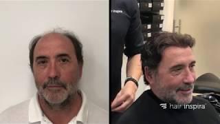 Aplicación de prótesis capilar indetectable (Xavier) parte 2 - Hair Inspira