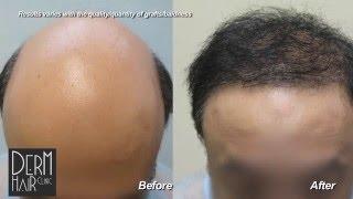 Los Angeles FUE hair restoration and Body hair transplant for severe baldness - Dr Umar