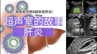 肝炎---超声室的故事【Ultrasound Room】Diagnosing Hepatitis on Ultrasound