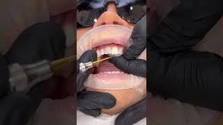 Composite bonding by Dr. Matt  #ruhdental #compositebonding