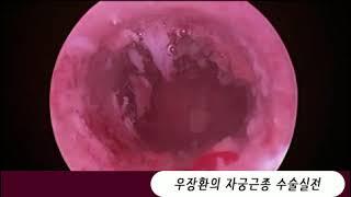 자궁경하 자궁내막 용종제거술 영상