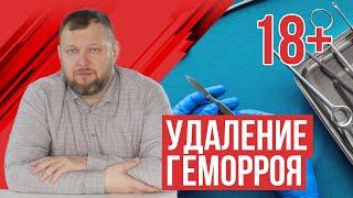 Удаление геморроя (видео операции)