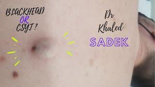 Blackhead or Cyst?! Dr Khaled Sadek. LipomaCyst.com