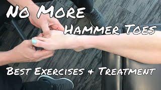 Hammer Toes: Over 90% Success Rate